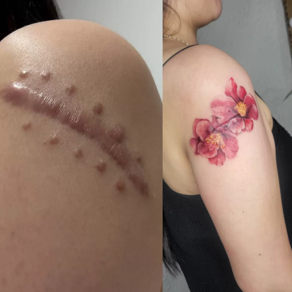 scar cover up of a flower on a shoulder of a female